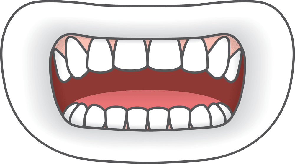 Open Mouth with Crooked Teeth – Braces Cartoon illustration of an open mouth showing crowded and misaligned teeth, demonstrating the need for orthodontics – Braces.