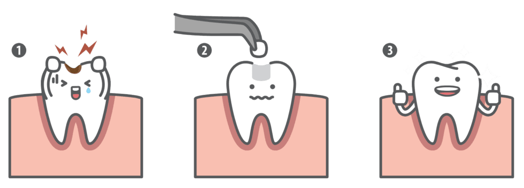 Illustration showing a tooth in pain, being filled, and restored to health in three simple steps – Dental Fillings.